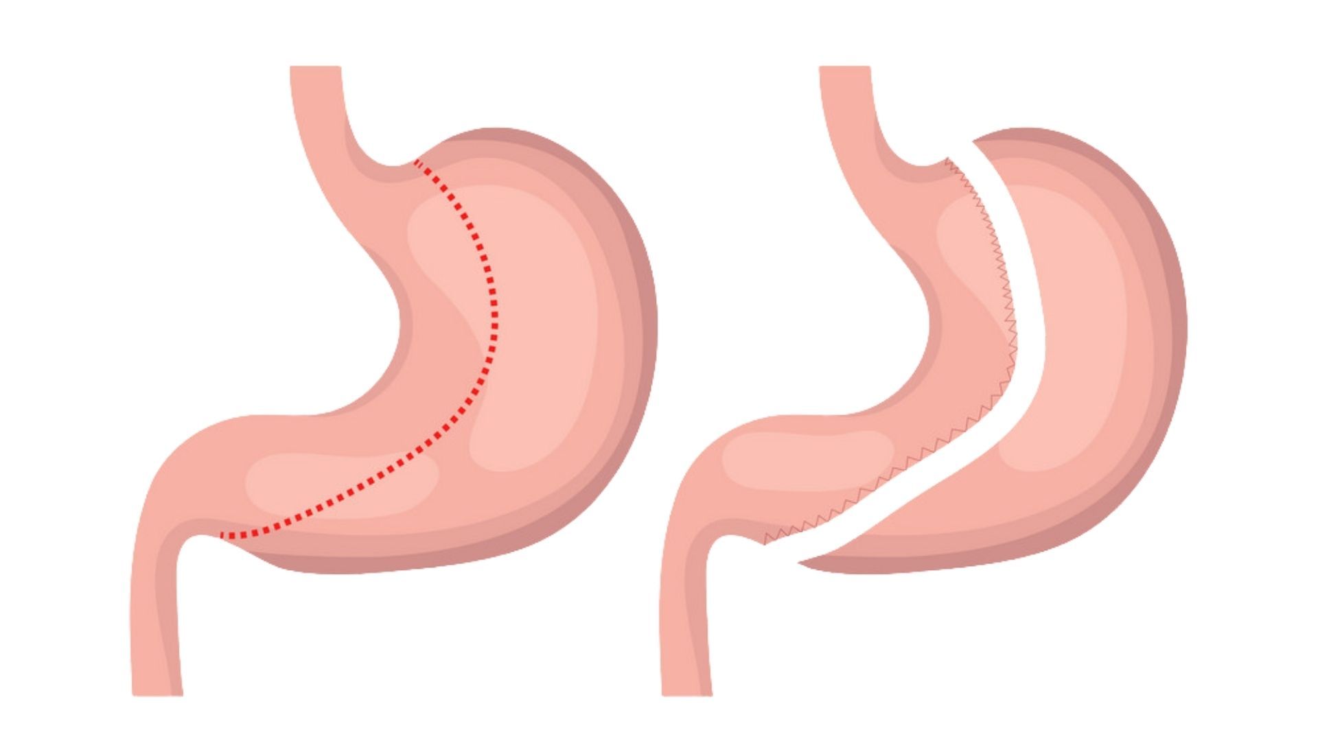 The Financial Aspect of Gastric Sleeve Surgery: What You Need to Know