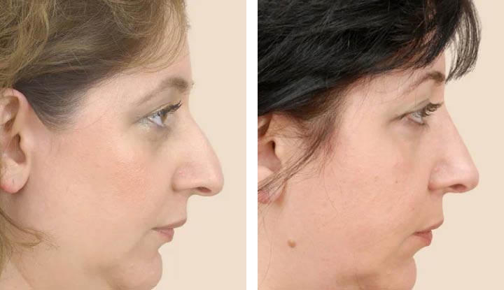 Understanding Nose Surgery: A Comprehensive Guide