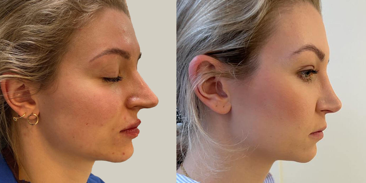 Reconstructive Nose Surgeons in Tehran: Excellence in Facial Restoration